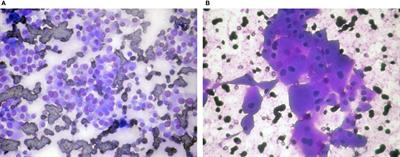 Challenges in Cytology Specimens With Hürthle Cells